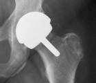 Hip replacement Complications