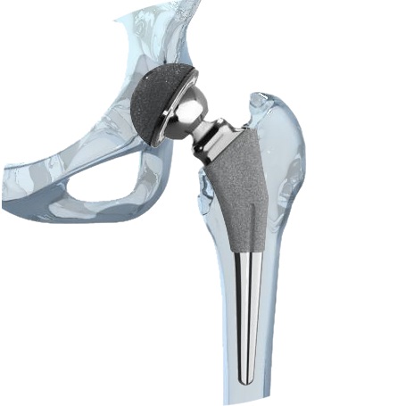 Hip Revision Surgery - Common Hip Replacement Lawsuit Allegation