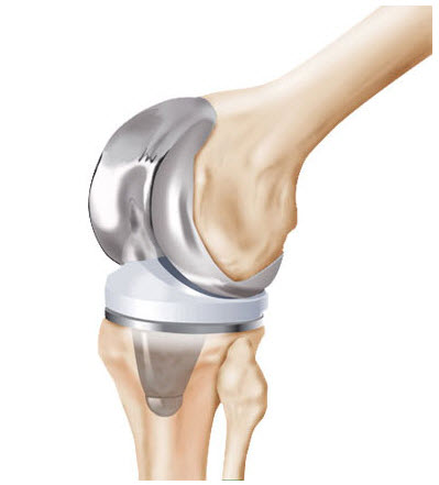 Infection and Mechanical Loosening Leading to Rise in Knee Replacement ...