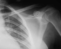 shoulder xray