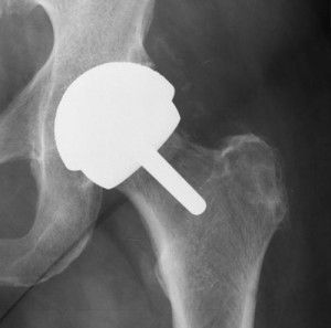 Hip replacement X Ray