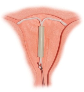 Mirena IntraUterine System